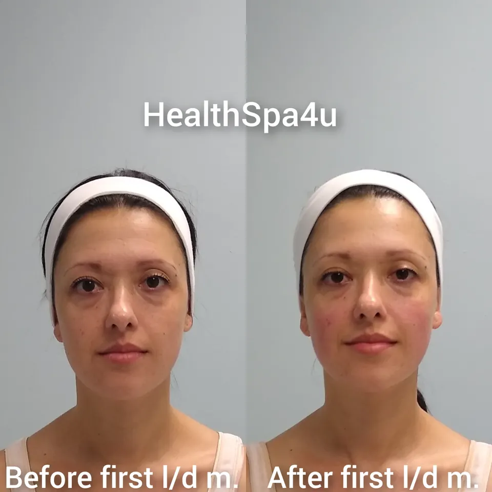 Antes y después – Drenaje Linfático Facial