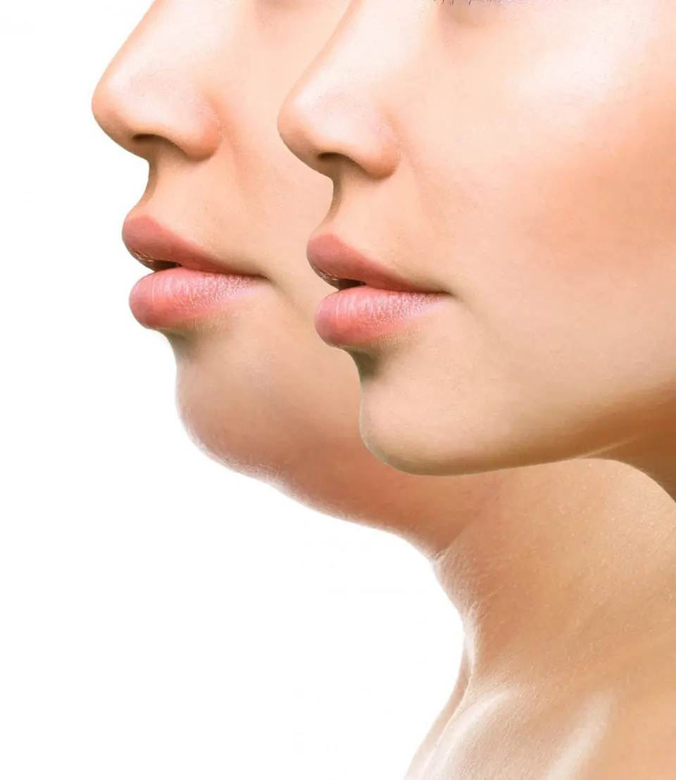 Enhance Your Recovery with a Post-Liposuction Chin Massage