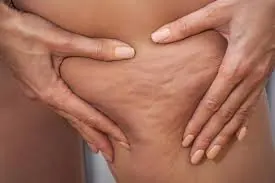 Celulitis