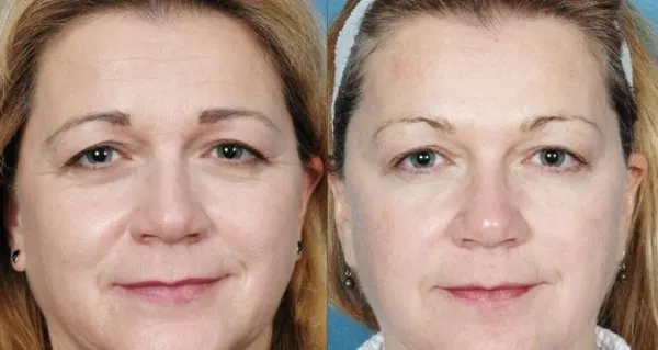 Antes y después – Drenaje Linfático Facial