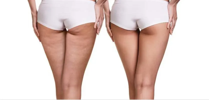 Antes y después – Programa SlimBody